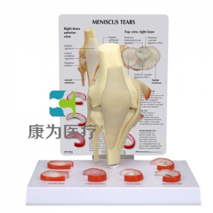 “康為醫療”醫患關系溝通模型-膝關節半月板撕裂模型 （醫學指導模型）